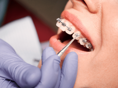 Orthodontic tool adjusting metal braces | Nudera Orthodontics